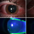 The Dangers of UV Light: What You Need to Know